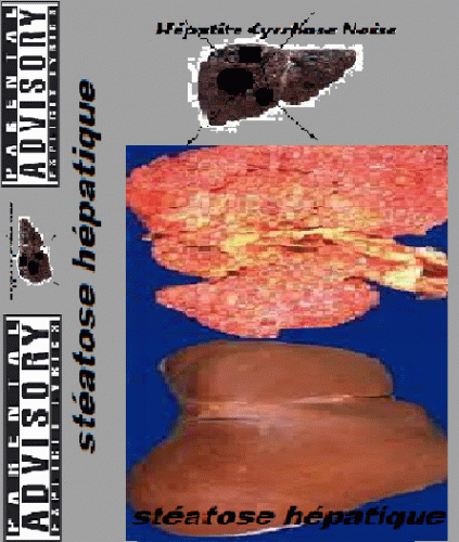 Hépatite Cyrrhose Noise : Steatose Hépatique